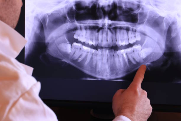 Best Emergency Dentist for Lost Fillings or Crowns in Onawa, IA
